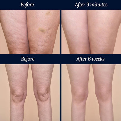 ADONIA LEGTONE – Natural cellulite cream – Organic cellulite treatment – Anti cellulite products - Soothes, relaxes, tightens, and firms the skin